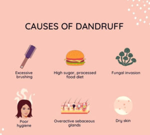 causes of dandruff